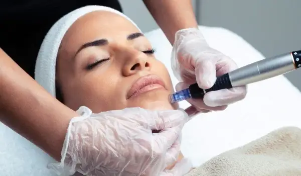 Microneedling Personalizado
